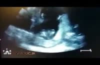 شادمانی جنین در شکم مادر! + فیلم