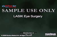 دکتر فرزاد فرزبد درباره عمل لیزر چشم توضیح می دهد .