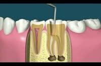 دندان - چگونگی بازسازی دندون به روش حرفه ای