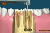 اموزش پزشکي: عصب کشی دندان