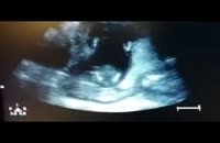 تصاویر سونوگرافی شادمانی جنین در شکم مادر