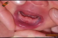 کلیپ آموزش پزشکی : نوزادانی که موقع تولد دندان دارند