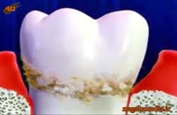 اموزش پزشکي: جرم دندان